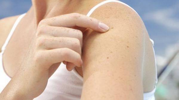 Πάνω από 11 ελιές στο μπράτσο δείχνουν αυξημένο κίνδυνο καρκίνου του δέρματος