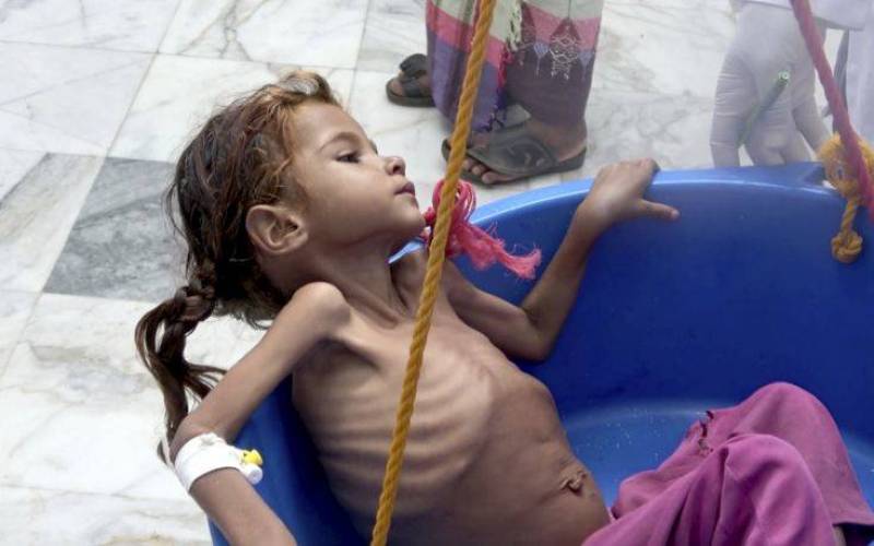 Περίπου 85.000 παιδιά κάτω των πέντε ετών έχουν πεθάνει από πείνα στην Υεμένη