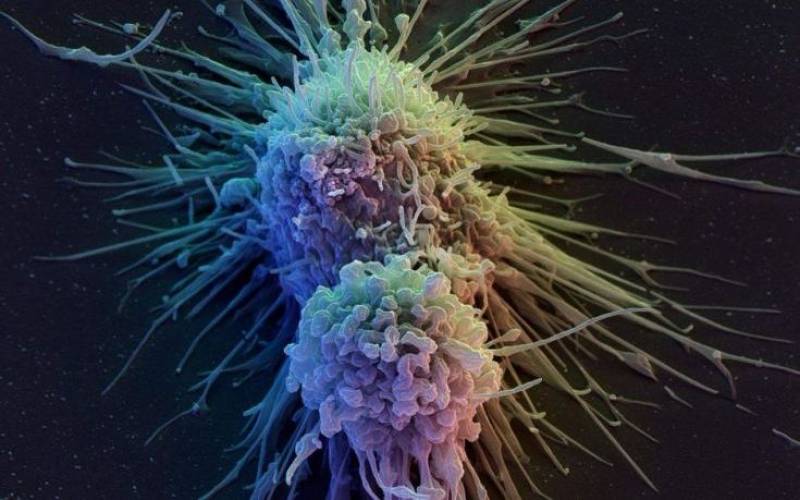 Η έγκαιρη διάγνωση «κλειδί» για την εξέλιξη του καρκίνου στο πάγκρεας