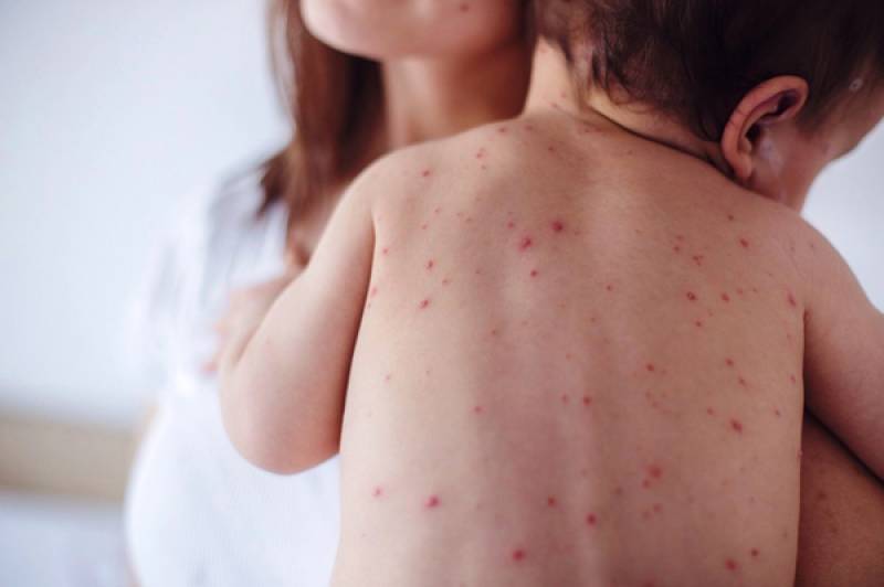 Στα 15 τα κρούσματα ιλαράς στη Μεσσηνία: Νεογέννητο από την Καλαμάτα στην εντατική του Παίδων